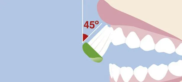 带牙套能用电动牙刷吗？牙护士为你解开疑惑